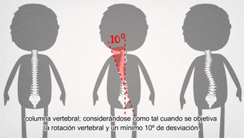 Fisioterapia ayuda a personas con escoliosis a llevar una vida normal